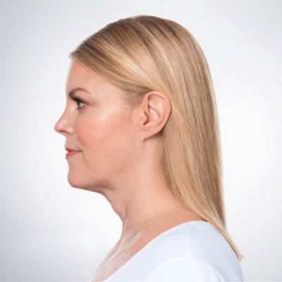 Kybella after