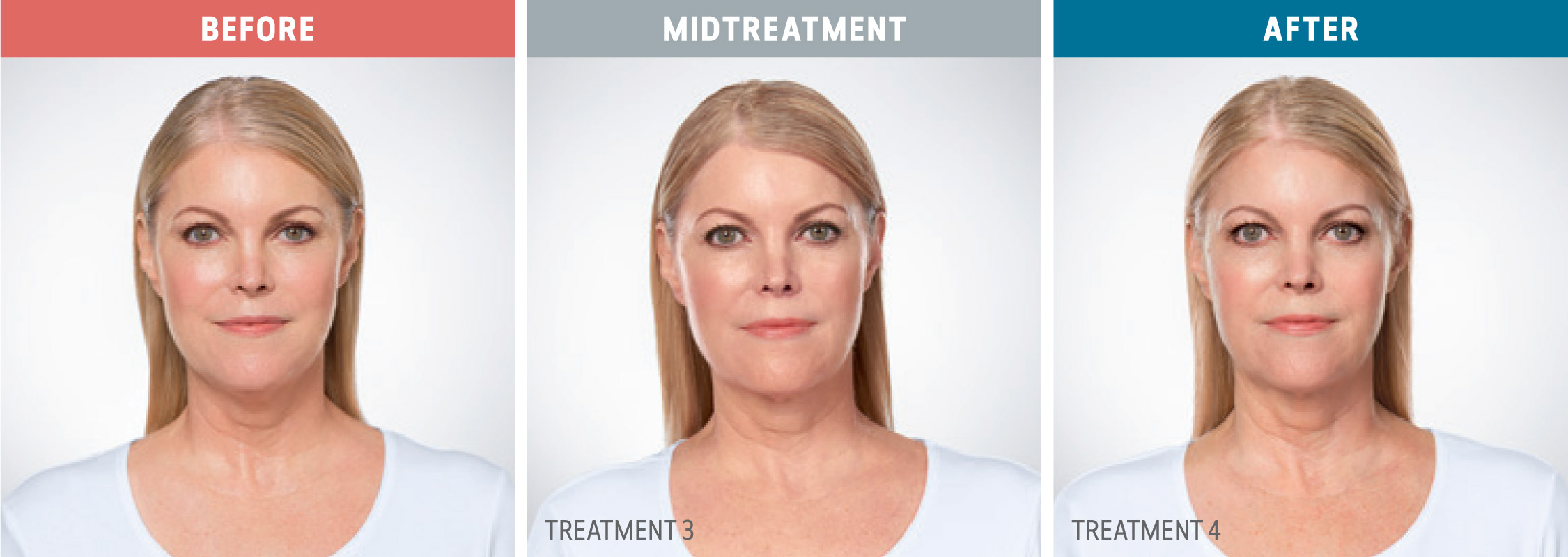 Kybella before, midtreatment, and after photos