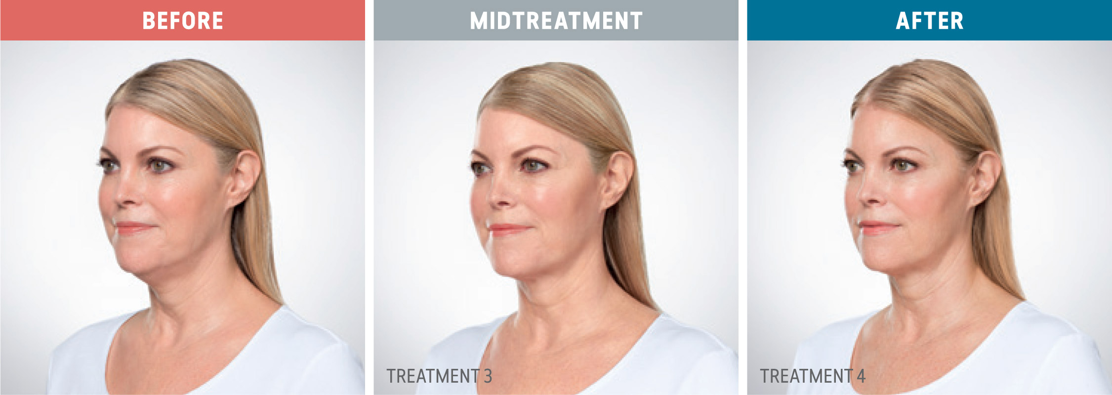 Kybella before, midtreatment, and after photos