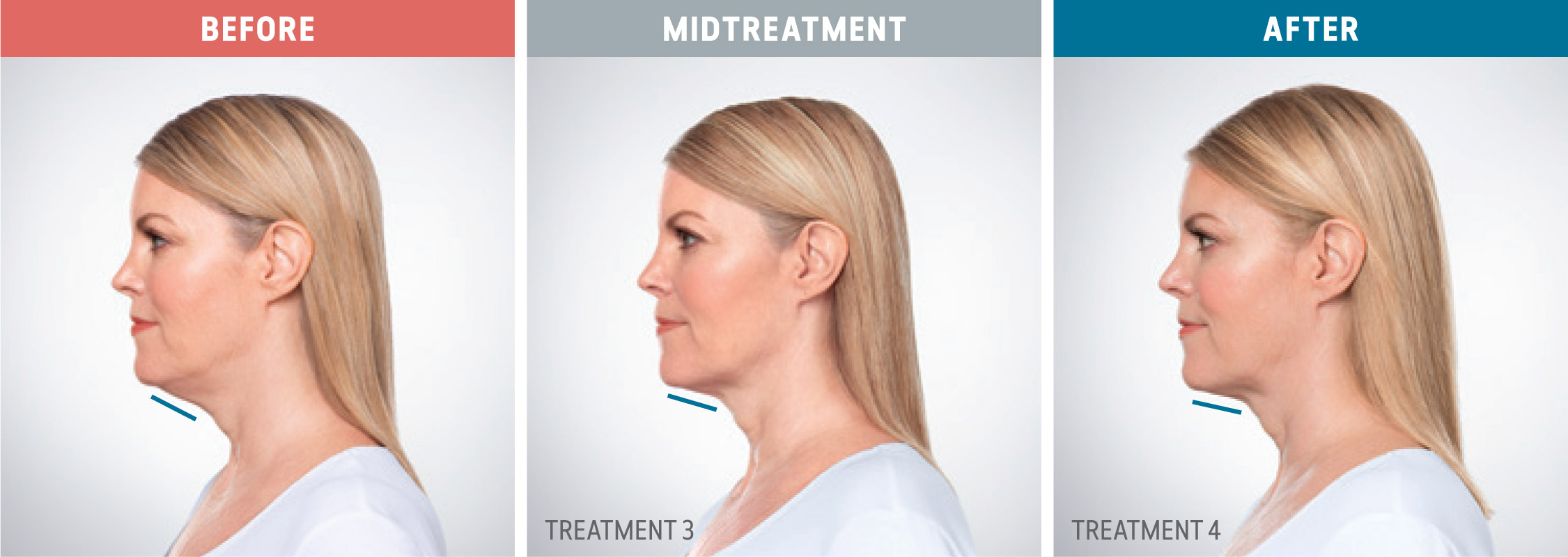 Kybella before, midtreatment, and after photos