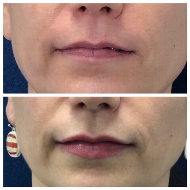 Before & After: Lips